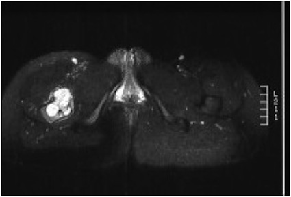 MRI Ewings Tumour Proximal Femur